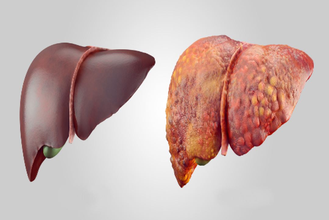 شكل الكبد التالف بعد تشمع الكبد