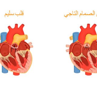 رسم توضيحي يبيّن قلب سليم وقلب مصاب بتضيّق الصمام التاجي