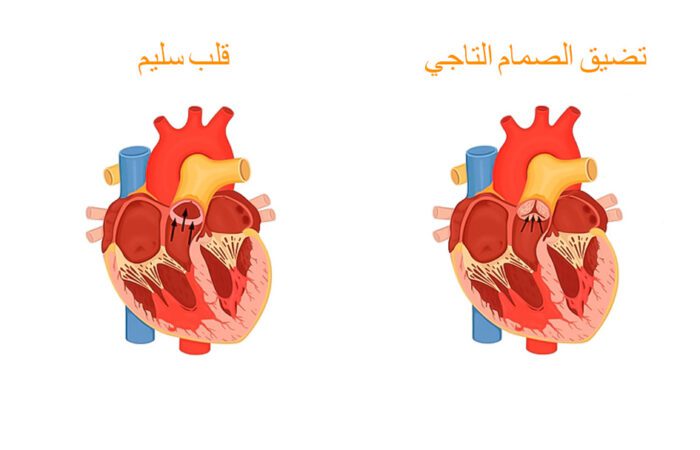 رسم توضيحي يبيّن قلب سليم وقلب مصاب بتضيّق الصمام التاجي