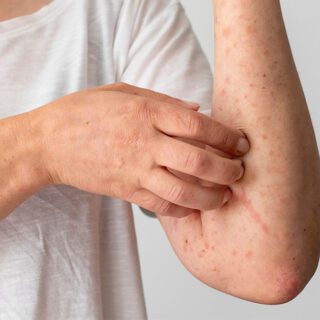 امرأة بالغة ترتدي كنزة بيضاء اللون وتقوم بحكّ زراعها التي يظهر عليها انتشار لبقع حمراء اللون