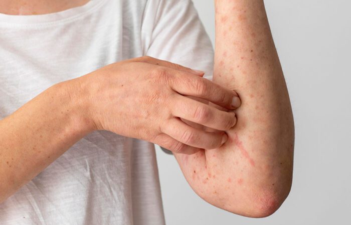 امرأة بالغة ترتدي كنزة بيضاء اللون وتقوم بحكّ زراعها التي يظهر عليها انتشار لبقع حمراء اللون