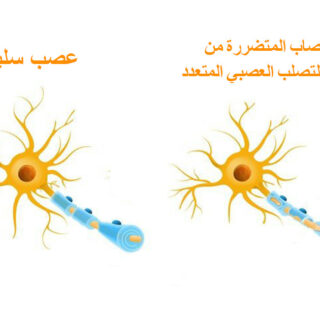 رسم توضيحي لعصب سليم وعصب مصاب