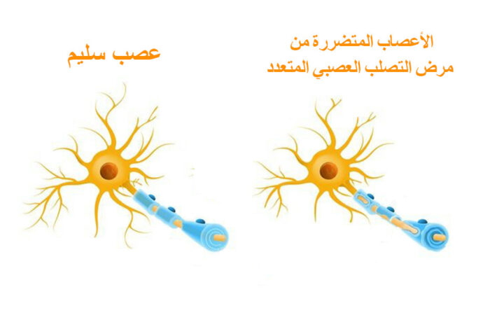 رسم توضيحي لعصب سليم وعصب مصاب