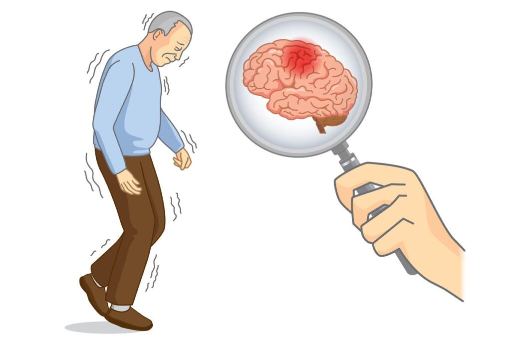 رسمة توضيحية لأعراض لاعتلال الدماغ الكبدي