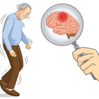 رسمة توضيحية لأعراض لاعتلال الدماغ الكبدي