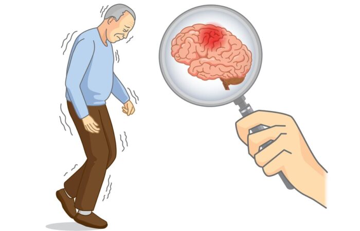 رسمة توضيحية لأعراض لاعتلال الدماغ الكبدي