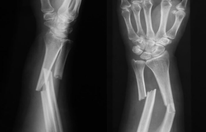 صورة شعاعية لكسر في اليد عند المصاب
