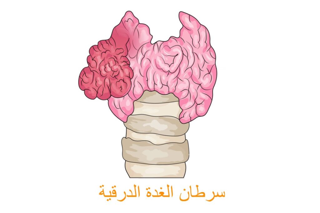 رسم توضيحي لسرطان الغدة الدرقية