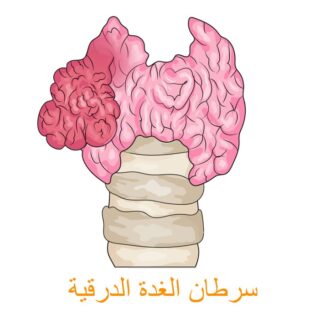 رسم توضيحي لسرطان الغدة الدرقية
