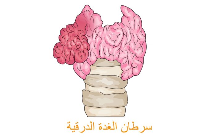 رسم توضيحي لسرطان الغدة الدرقية
