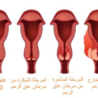 رسم توضيحي لمراحل تطور سرطان عنق الرحم لدى المرأة