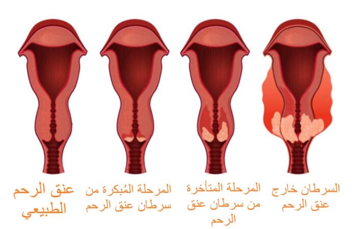 رسم توضيحي لمراحل تطور سرطان عنق الرحم لدى المرأة