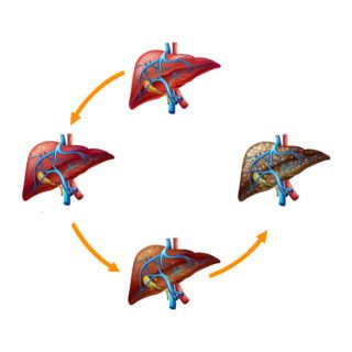 رسمة توضيحية لتغير شكل الكبد بعد إصابته بتشمع الكبد