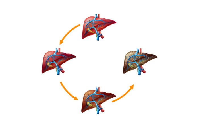 رسمة توضيحية لتغير شكل الكبد بعد إصابته بتشمع الكبد