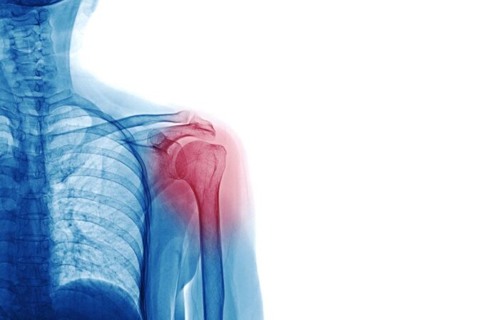 صورة شعاعية ملونة بالأزرق لشخص مخلوع كتفه وتظهر بقعة حمراء فوق منطقة الكتف
