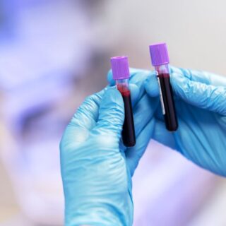 عينتين من الدم في يد طبيب في المخبر