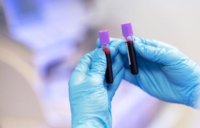 عينتين من الدم في يد طبيب في المخبر