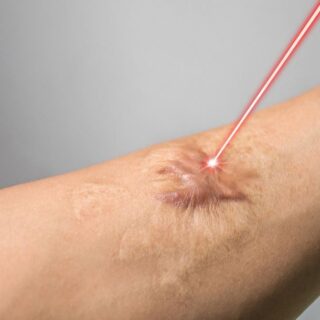 شعاع ليزر موجّه نحو ندبة على يد شخص