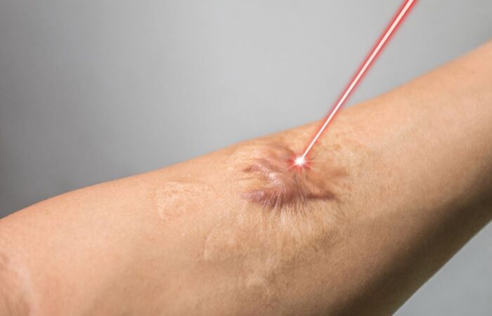 شعاع ليزر موجّه نحو ندبة على يد شخص