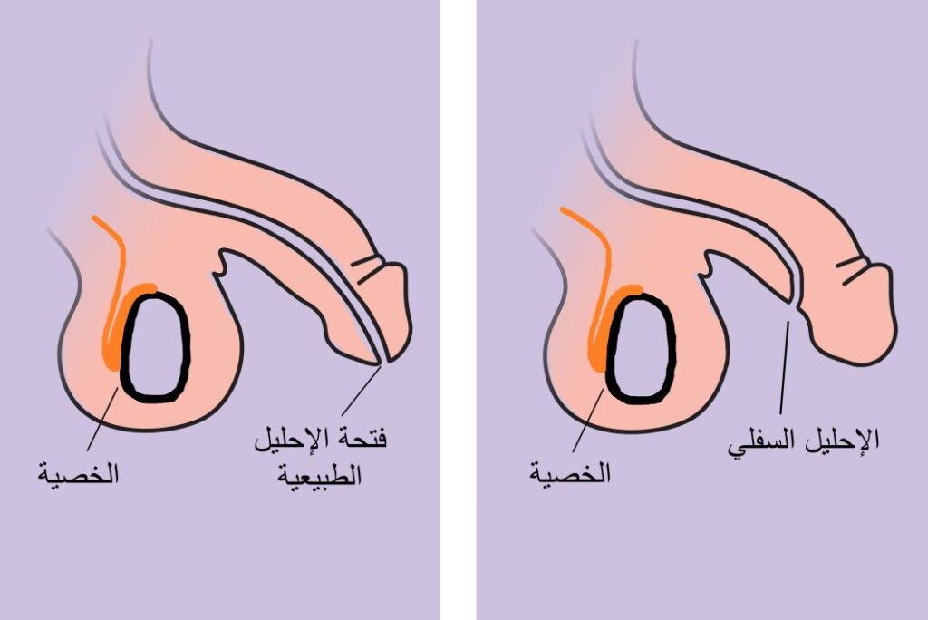 رسم توضيحي لعضو ذكري بالشكل الطبيعي وعضو ذكري له فتحة من الأسفل