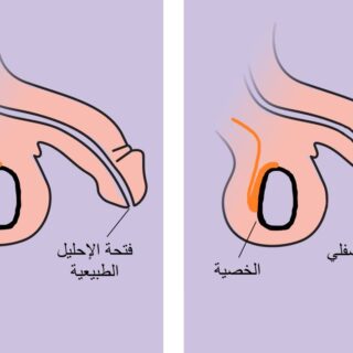 رسم توضيحي لعضو ذكري بالشكل الطبيعي وعضو ذكري له فتحة من الأسفل