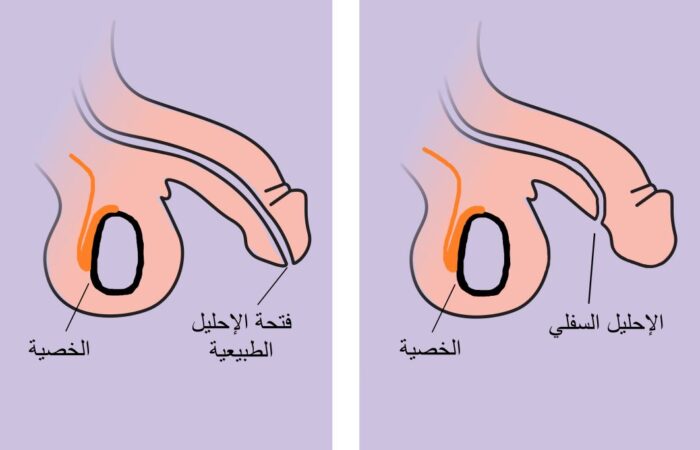 رسم توضيحي لعضو ذكري بالشكل الطبيعي وعضو ذكري له فتحة من الأسفل