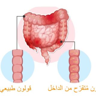 رسم توضيحي لقولون عصبي فيه تقرحات