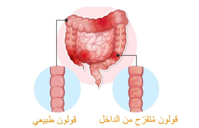 رسم توضيحي لقولون عصبي فيه تقرحات
