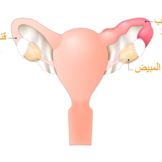 رسم توضيحي للداء الحوضي الالتهابي عند المرأة