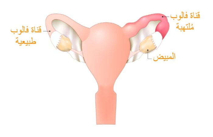 رسم توضيحي للداء الحوضي الالتهابي عند المرأة
