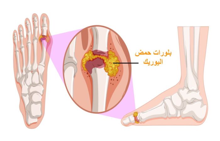 رسم توضيحي لعظام أصابع القدم عند الإنسان وتظهر بقعة صفراء وحمراء اللون بين مفاصل أحد الأصابع