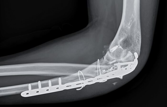 صورة شعاعية لمفصل يد توجد به صفيحة معدنية مثبتة ببراغي داخل العظم