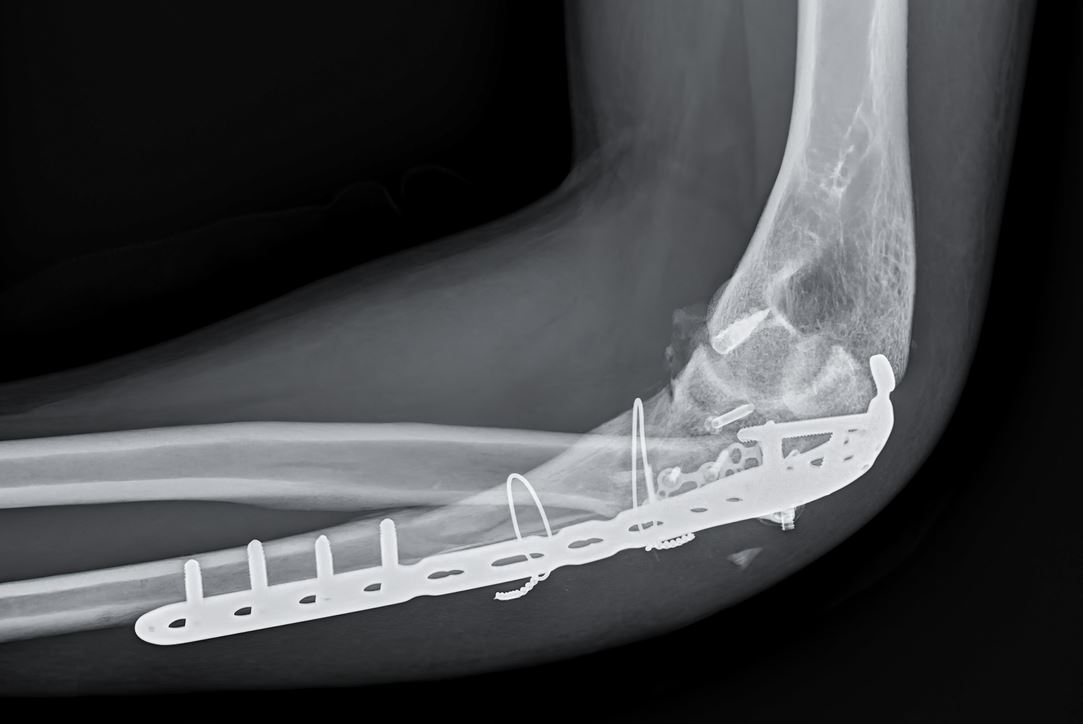 صورة شعاعية لكسر في الرجل متصل بها قطعة تبيت الكسور