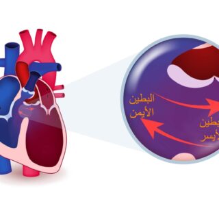 رسم توضيحي للفتحة في القلب بين البطين الأيمن والبطين الأيسر