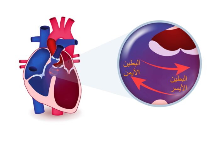 رسم توضيحي للفتحة في القلب بين البطين الأيمن والبطين الأيسر