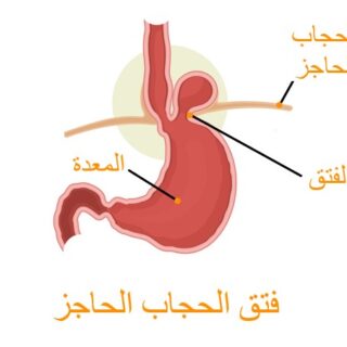 رسم توضيحي لظهور كتلة فوق المعدة