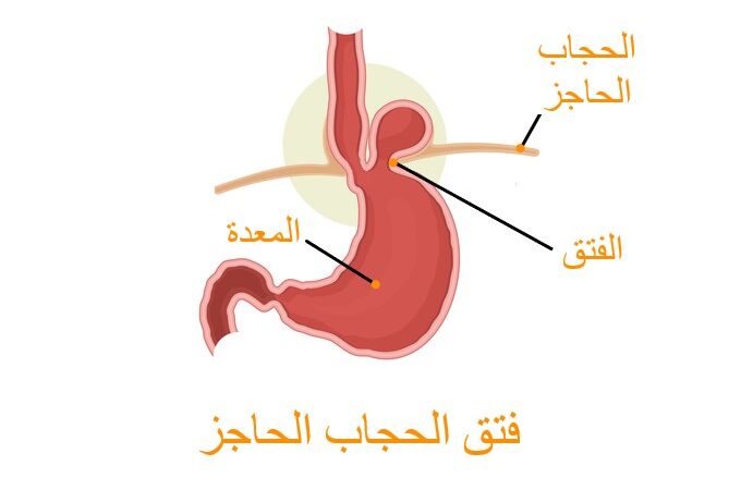 رسم توضيحي لظهور كتلة فوق المعدة