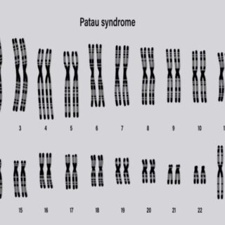 رسم توضيحي لشكل الصبغي في متلازمة باتو