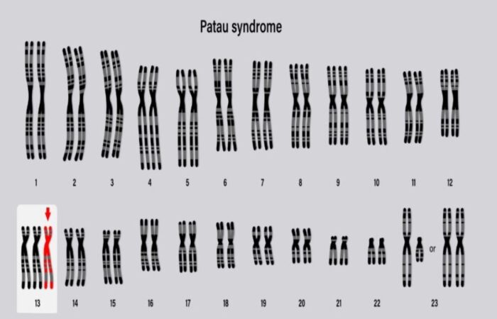 رسم توضيحي لشكل الصبغي في متلازمة باتو
