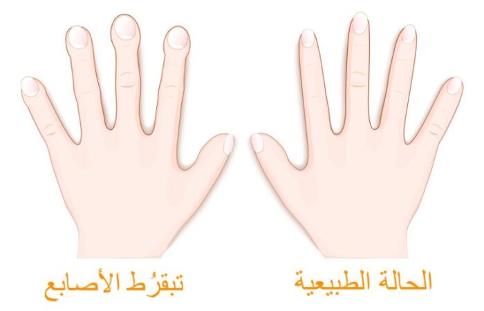رسمة توضيحية للفرق بين أصابع يد طبيعية وتبقرُط الأصابع