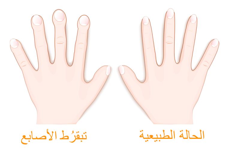 الفرق بين أصابع يد طبيعية وتبقرُط الأصابع