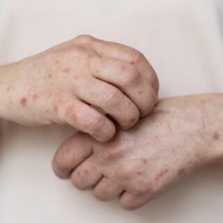 يديّ شخص بالغ وتظهر بقع حمراء منتشرة على جلده