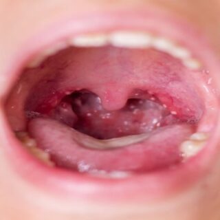 طفل مصاب بالحمى القرمزية في فمه