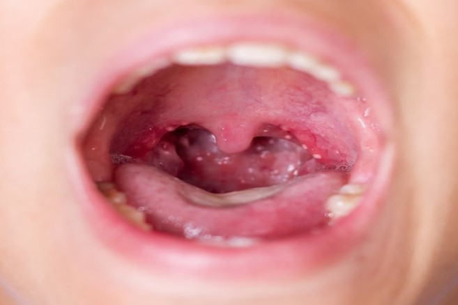 طفل مصاب بالحمى القرمزية في فمه