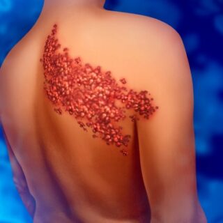 رسمة توضيحية لشخص مصاب بطفح جلدي أحمر على كتفه