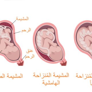 رسم توضيحي للحالات المختلفة لموضع المشيمة