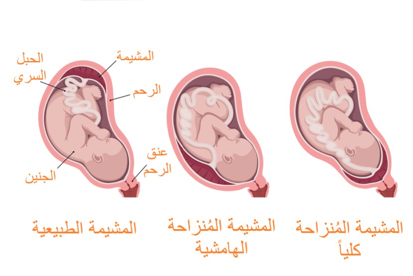 رسم توضيحي للحالات المختلفة لموضع المشيمة