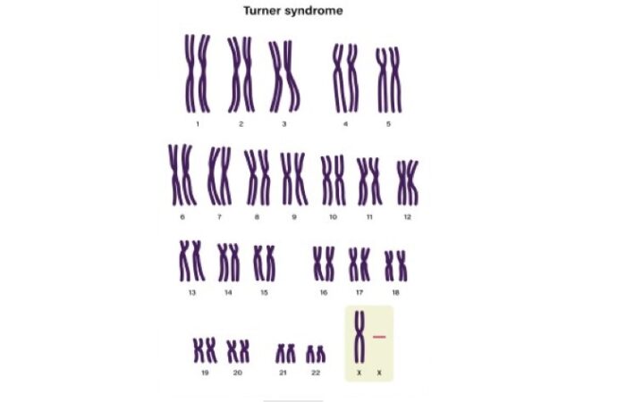رسمة توضيحية لصبغيات متلازمة تيرنر
