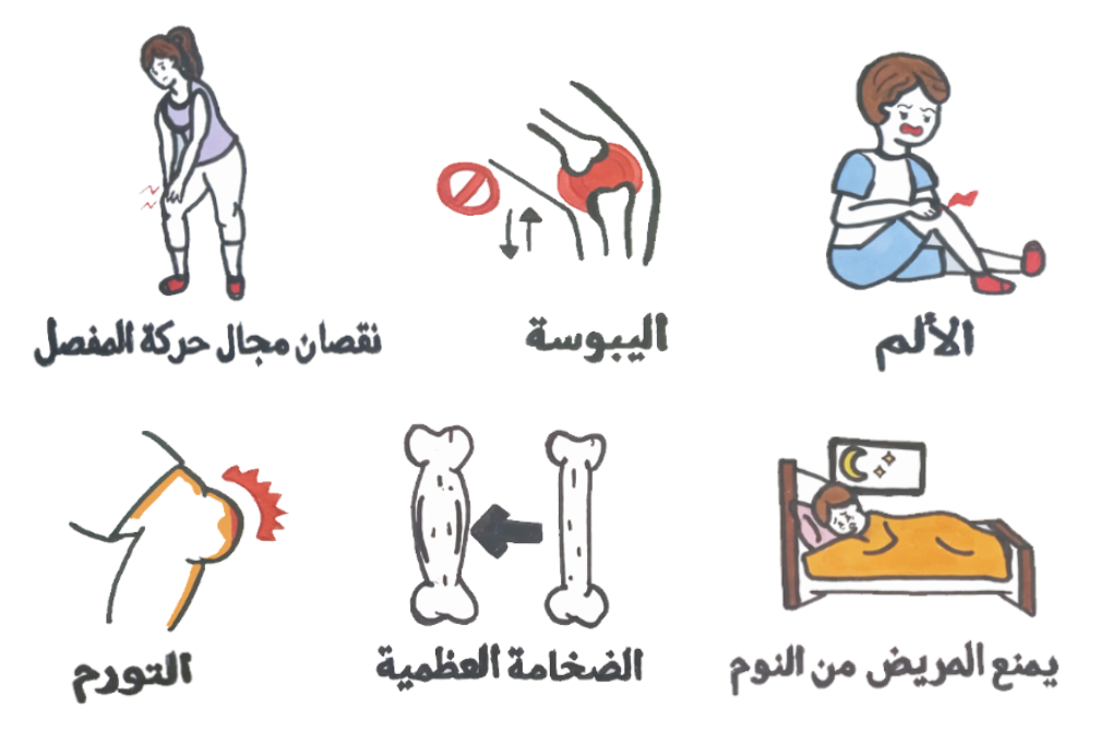 رسمة توضيحية لأعراض الفصال العظمي