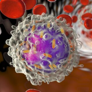 خلية مصابة بالابيضاض اللمفاوي